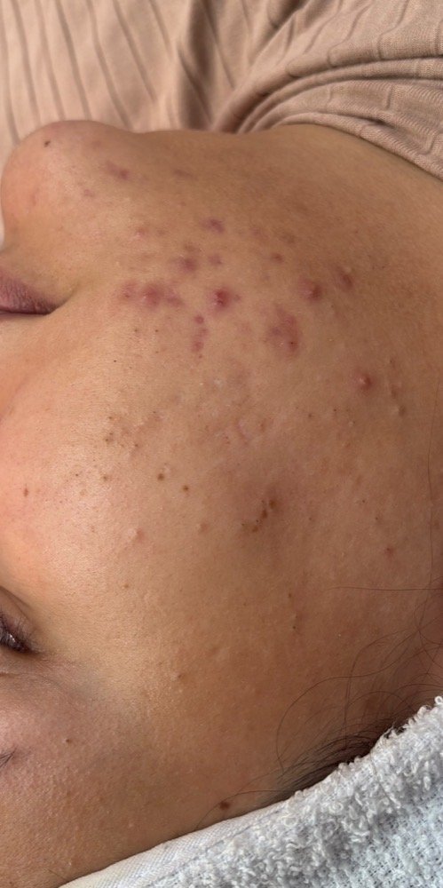 Antes: acne inflamada na bochecha