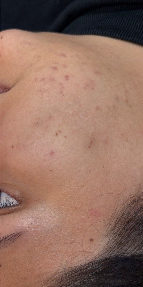 Depois: menos inflamação